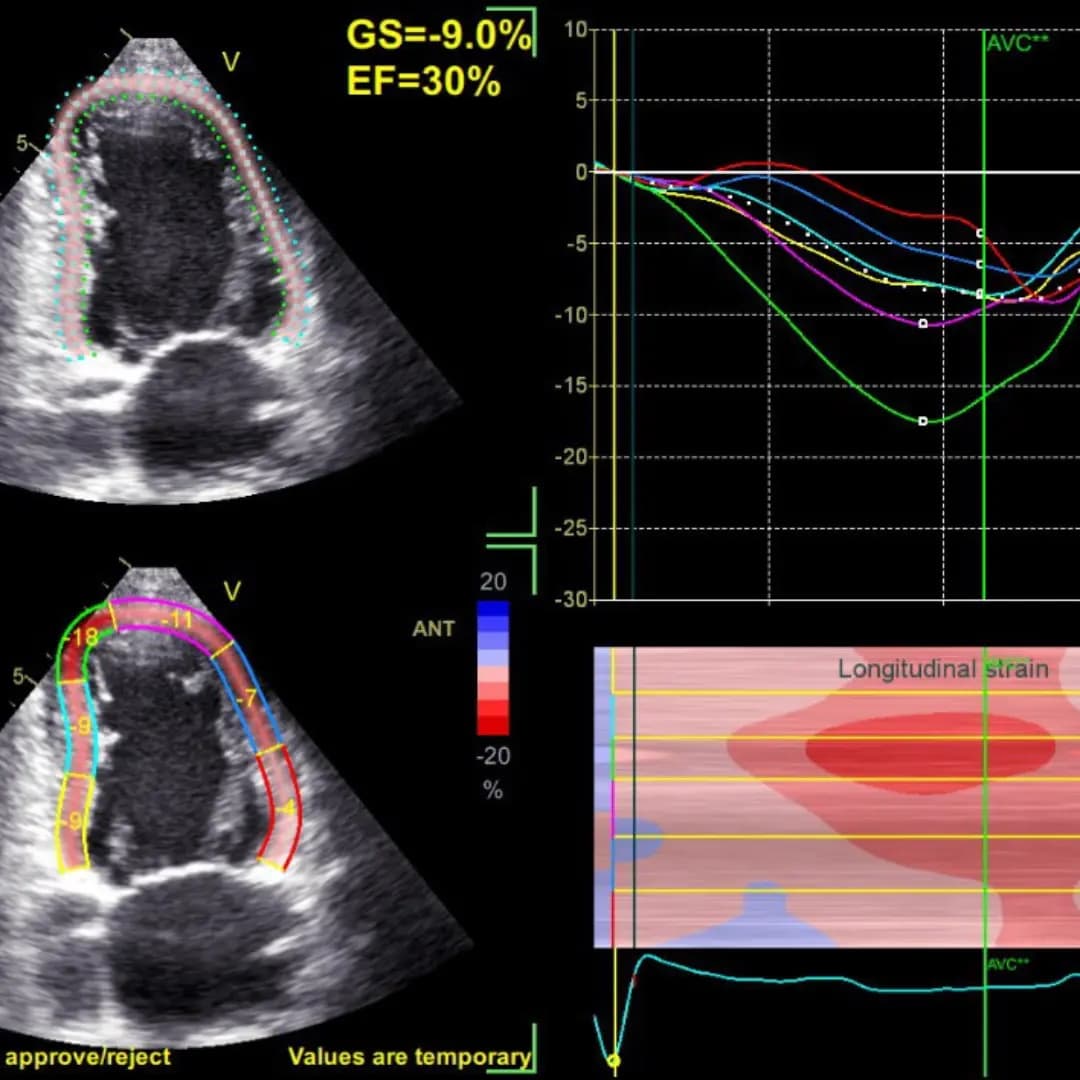 Стрейн ЕхоКГ (спрекл-трекінг)